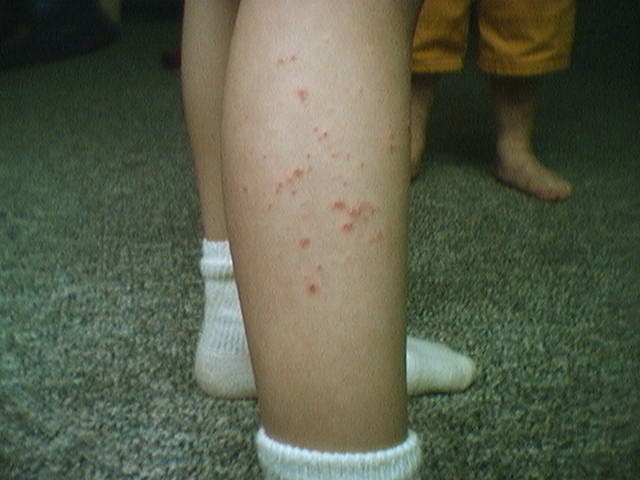 poison ivy rash. poison ivy rash