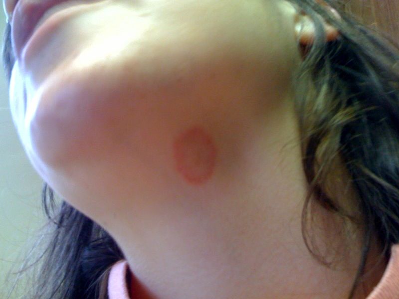 ringworm on neck