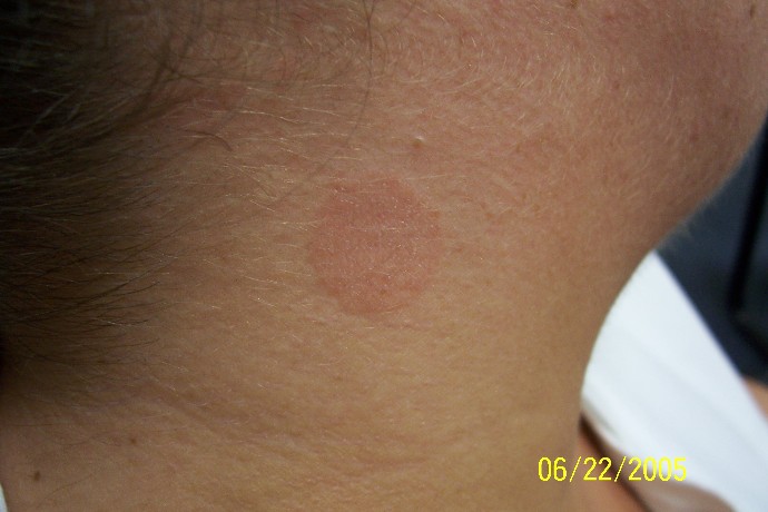 treatment for ringworm. Children with ringworm can
